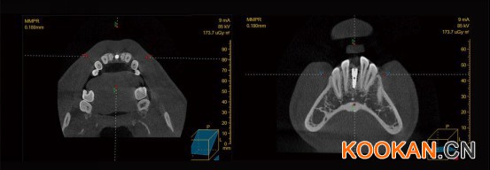 CBCT高品質(zhì)影像質(zhì)量